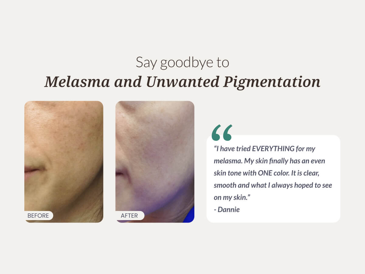 Root Cause Melasma Bundle